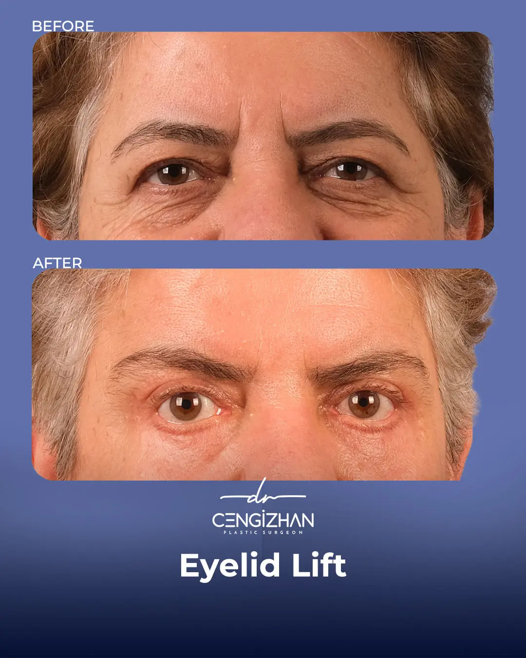 Eyelid Lift Surgery Results (Real Patient  Photo) by Dr. Cengizhan Ekizceli