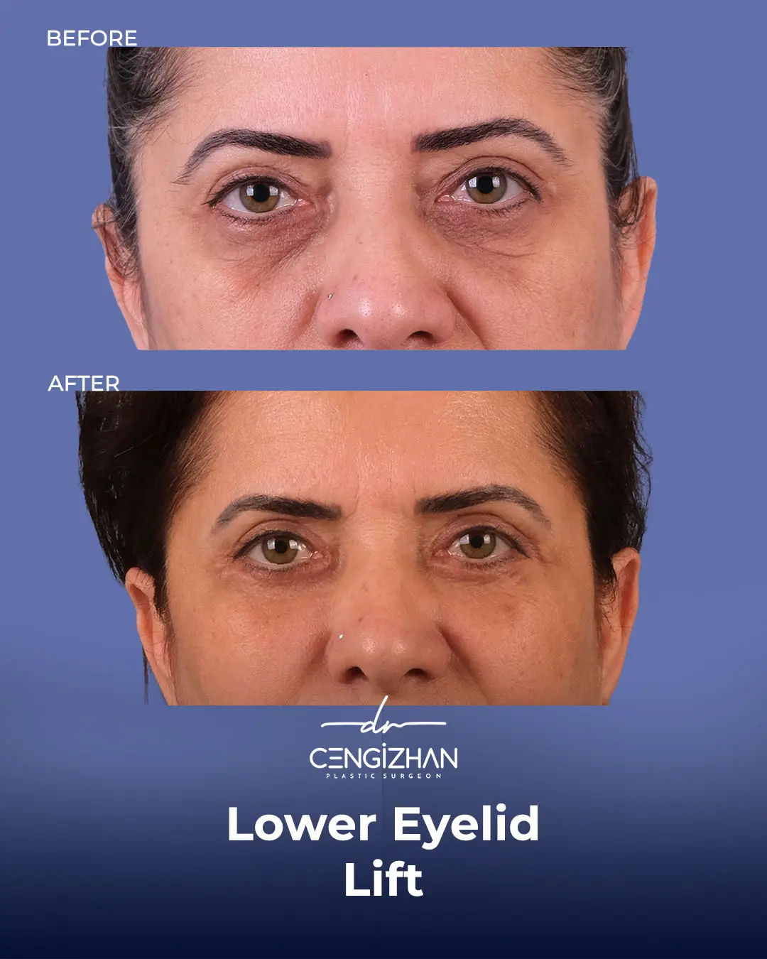 Eyelid Lift Surgery Results (Real Patient  Photo) by Dr. Cengizhan Ekizceli