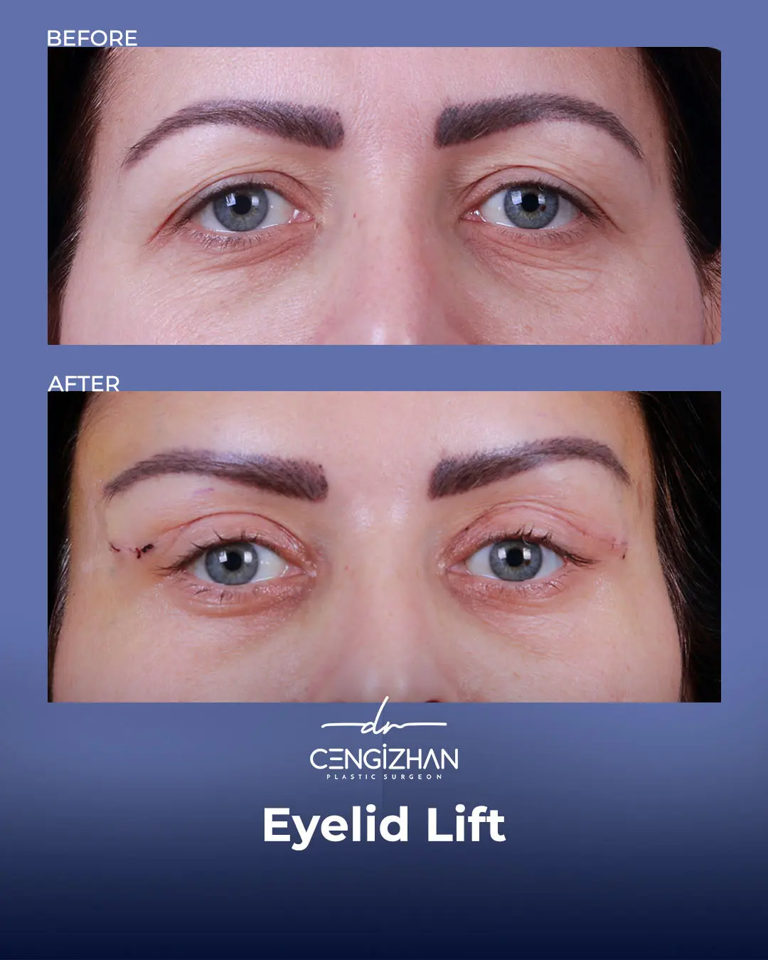 Eyelid Lift Surgery Results (Real Patient  Photo) by Dr. Cengizhan Ekizceli