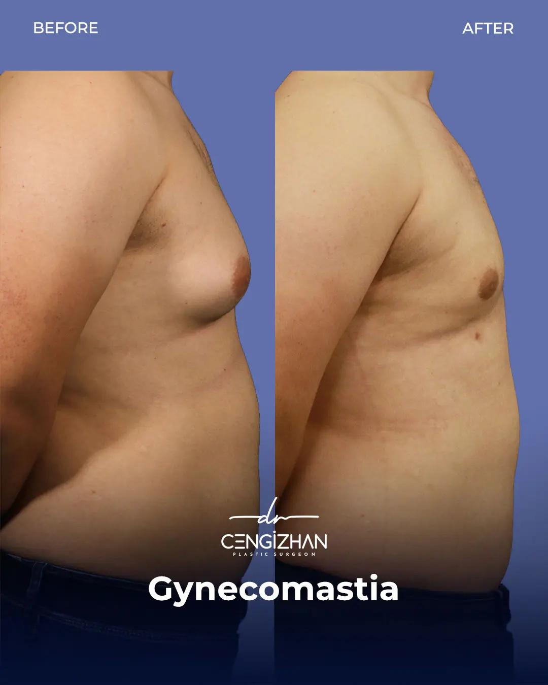 Gynecomastia Before and After by Dr. Cengizhan Ekizceli