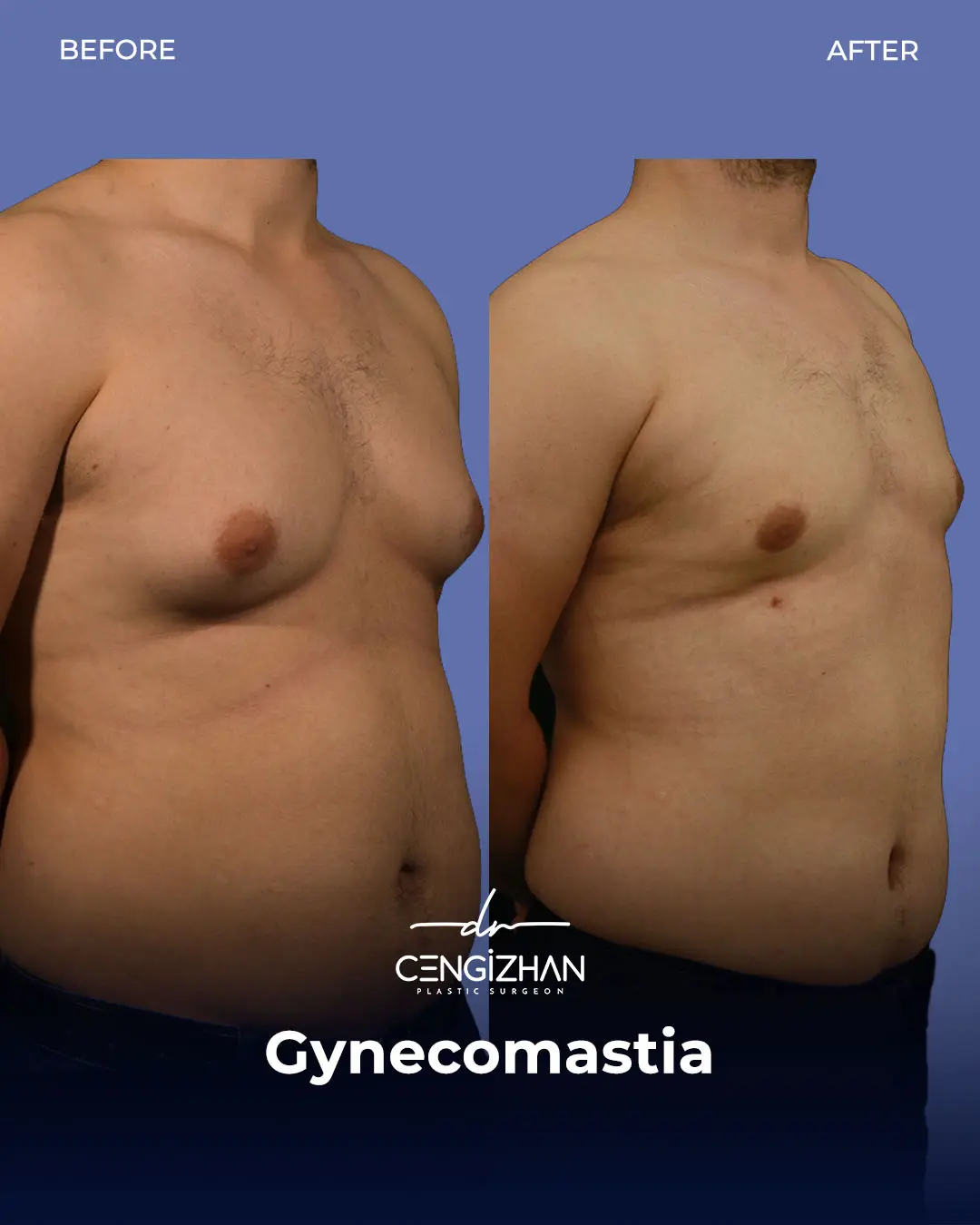 Gynecomastia Before and After by Dr. Cengizhan Ekizceli
