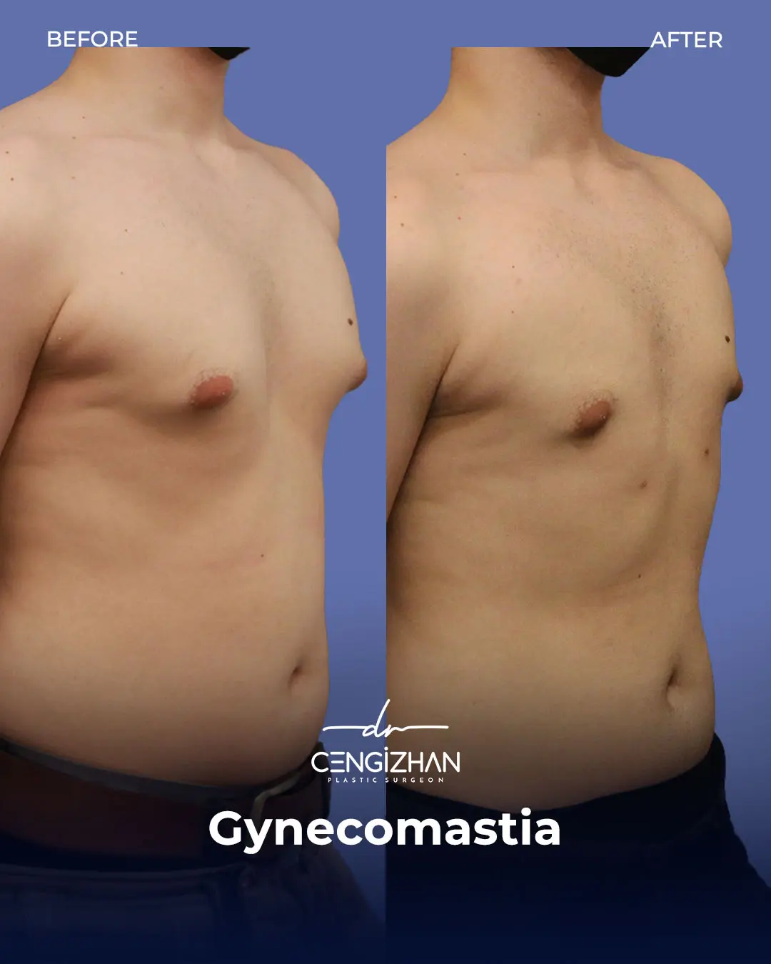 Gynecomastia Before and After by Dr. Cengizhan Ekizceli