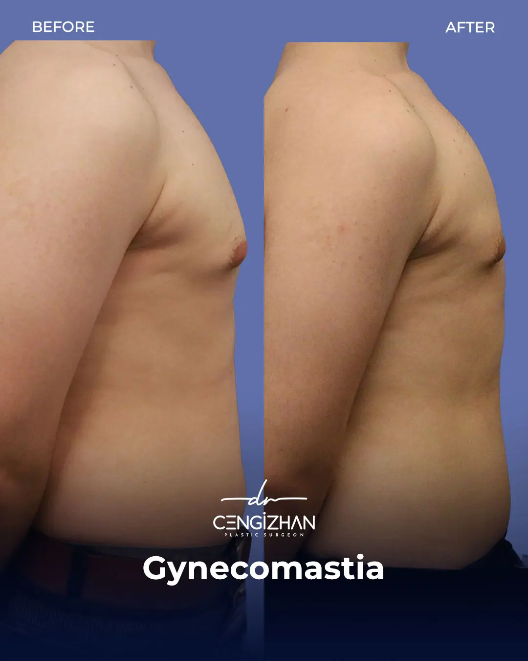 Gynecomastia Before and After by Dr. Cengizhan Ekizceli