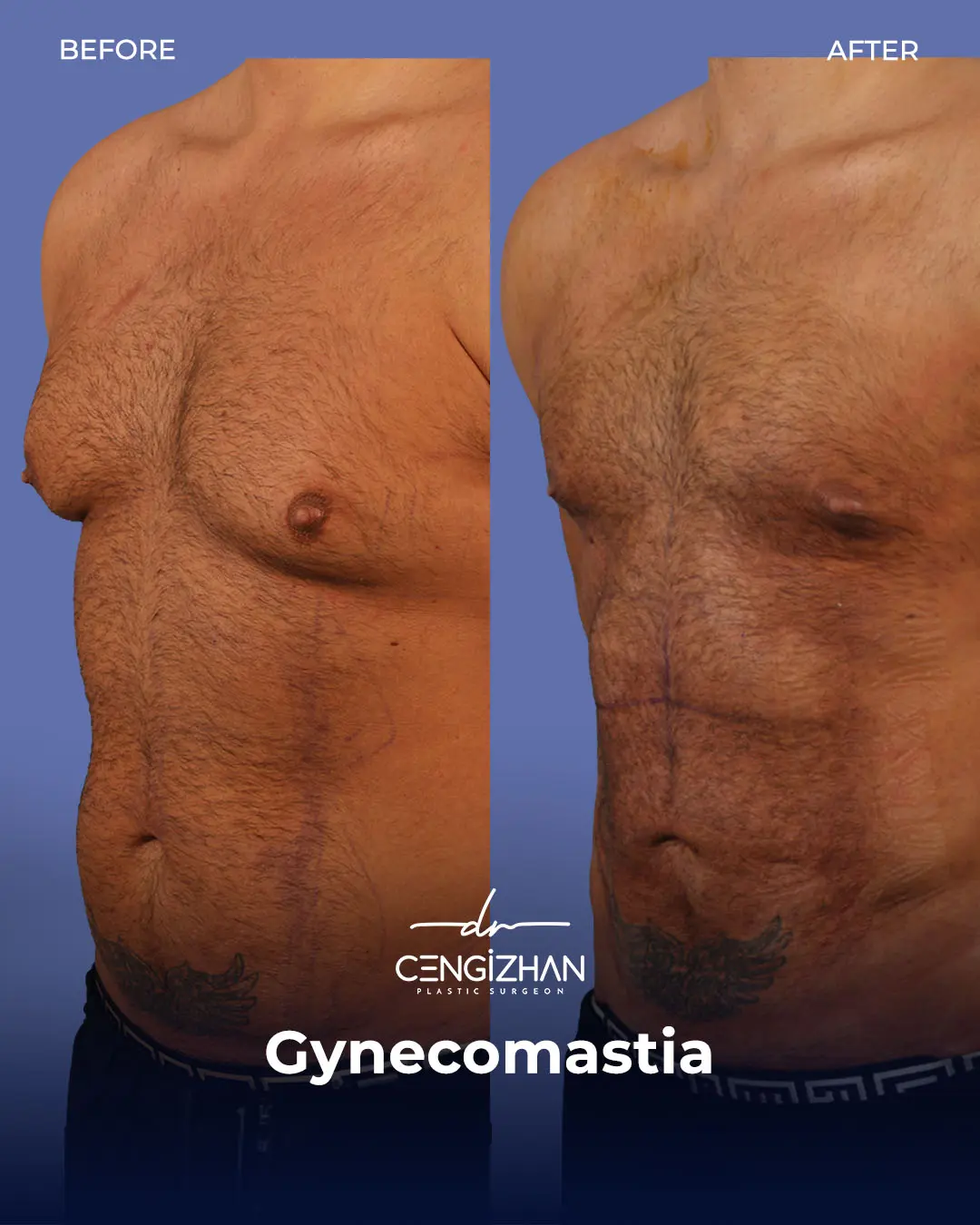 Gynecomastia Before and After by Dr. Cengizhan Ekizceli