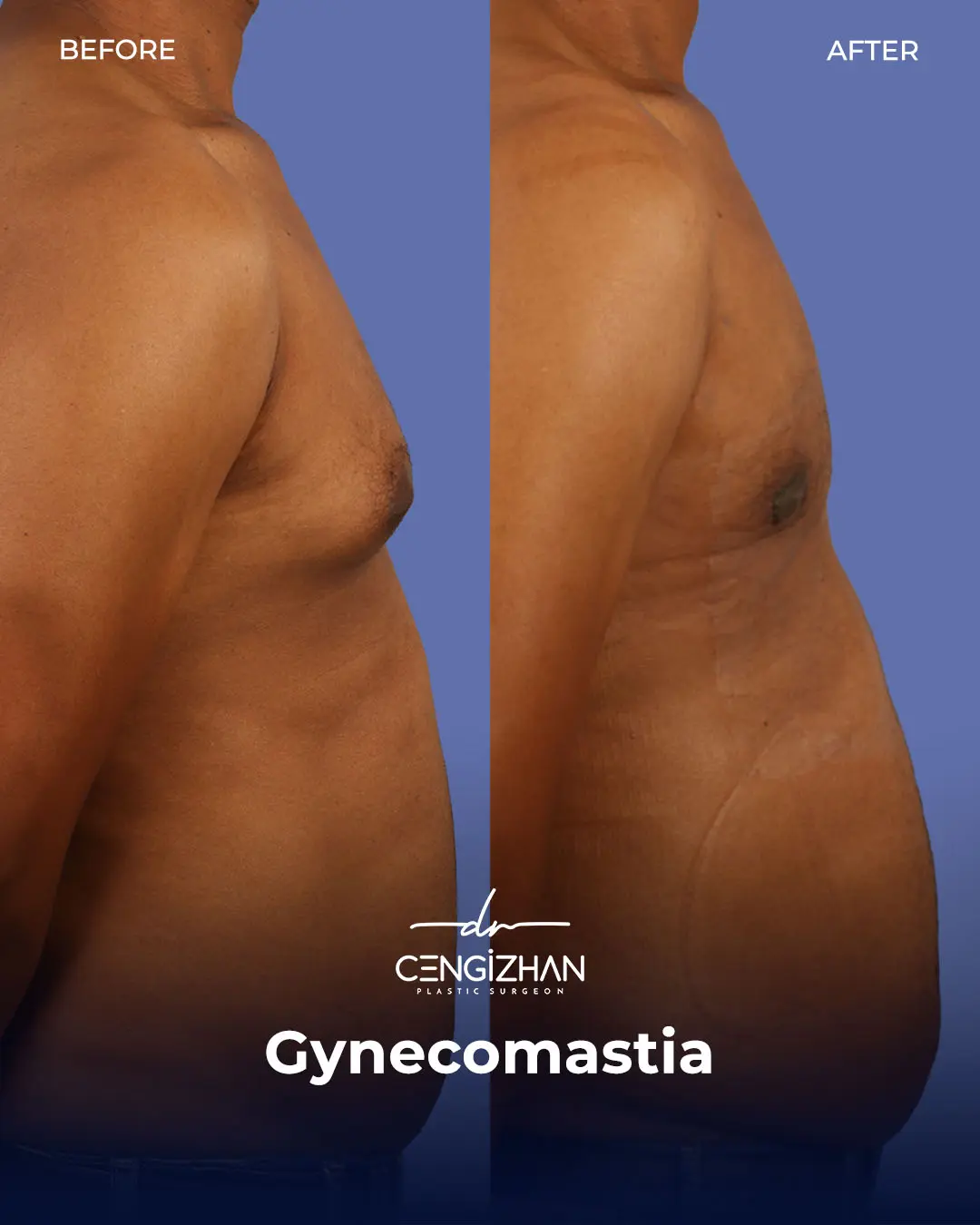 Gynecomastia Before and After by Dr. Cengizhan Ekizceli