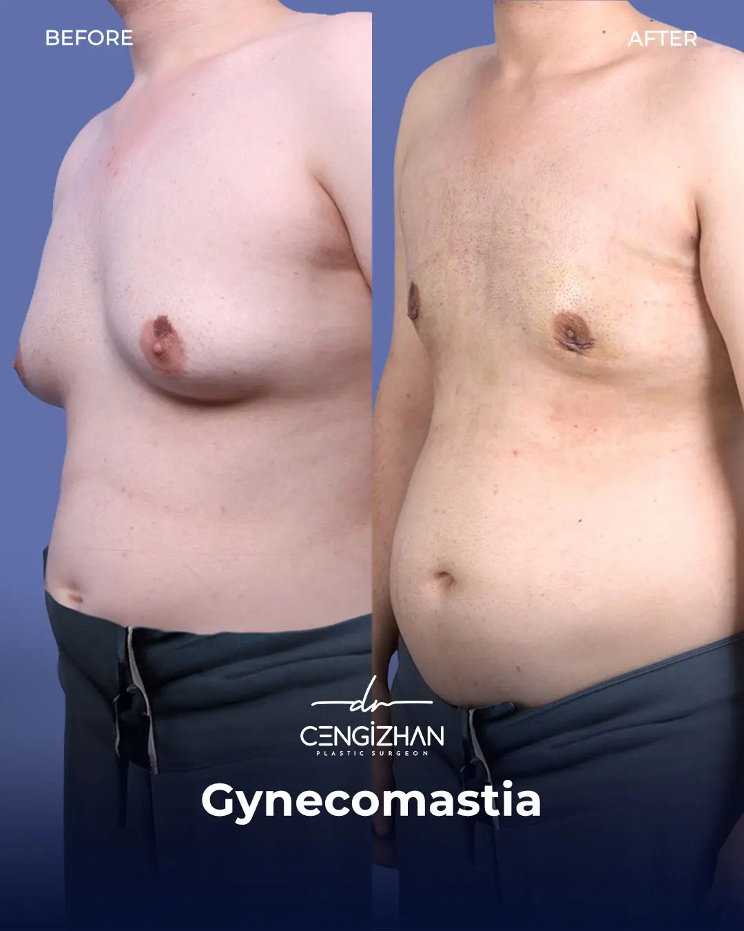 Gynecomastia Before and After by Dr. Cengizhan Ekizceli