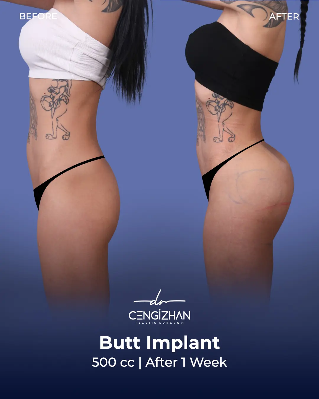 Butt Implants - Before and After - Real Transformation by Dr. Cengizhan Ekizceli