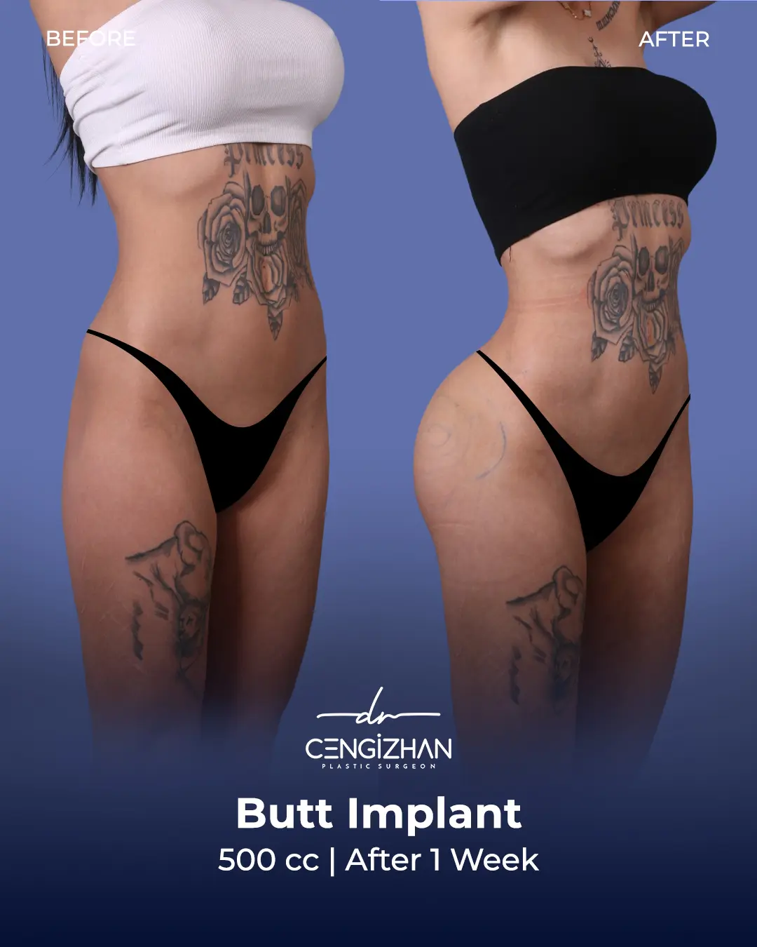 Butt Implants - Before and After - Real Transformation by Dr. Cengizhan Ekizceli
