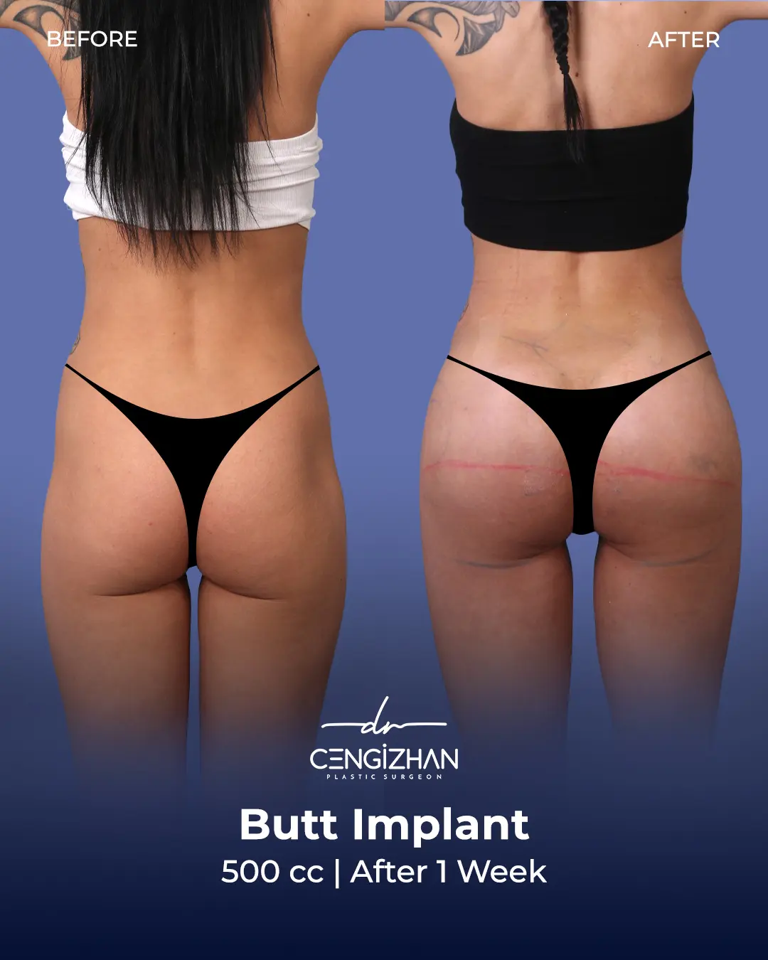 Butt Implants - Before and After - Real Transformation by Dr. Cengizhan Ekizceli