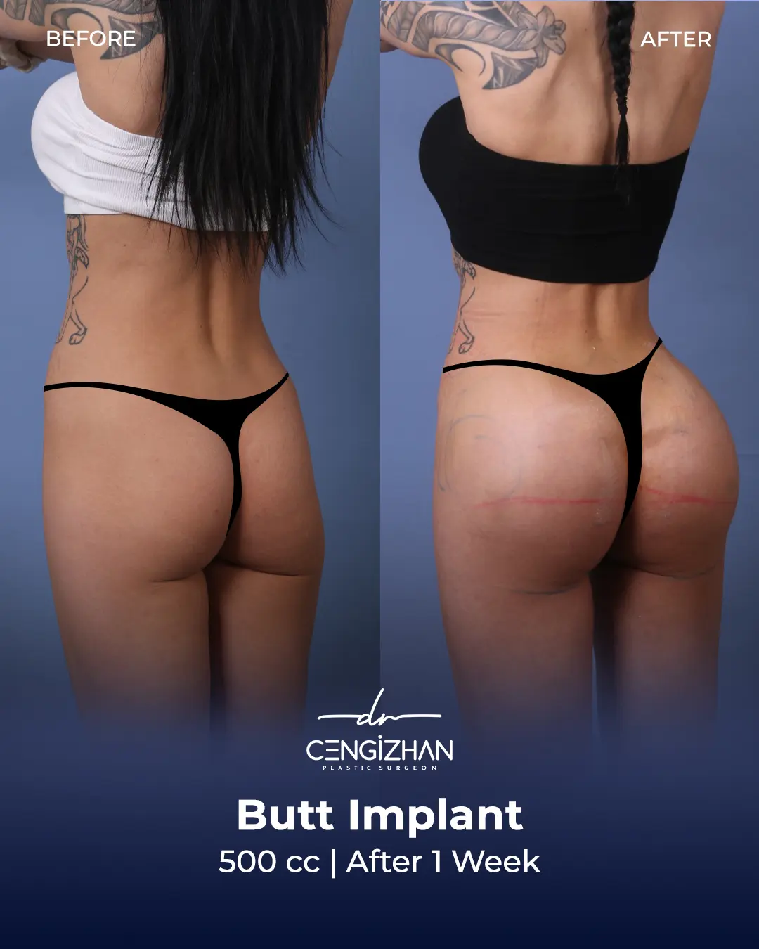 Butt Implants - Before and After - Real Transformation by Dr. Cengizhan Ekizceli