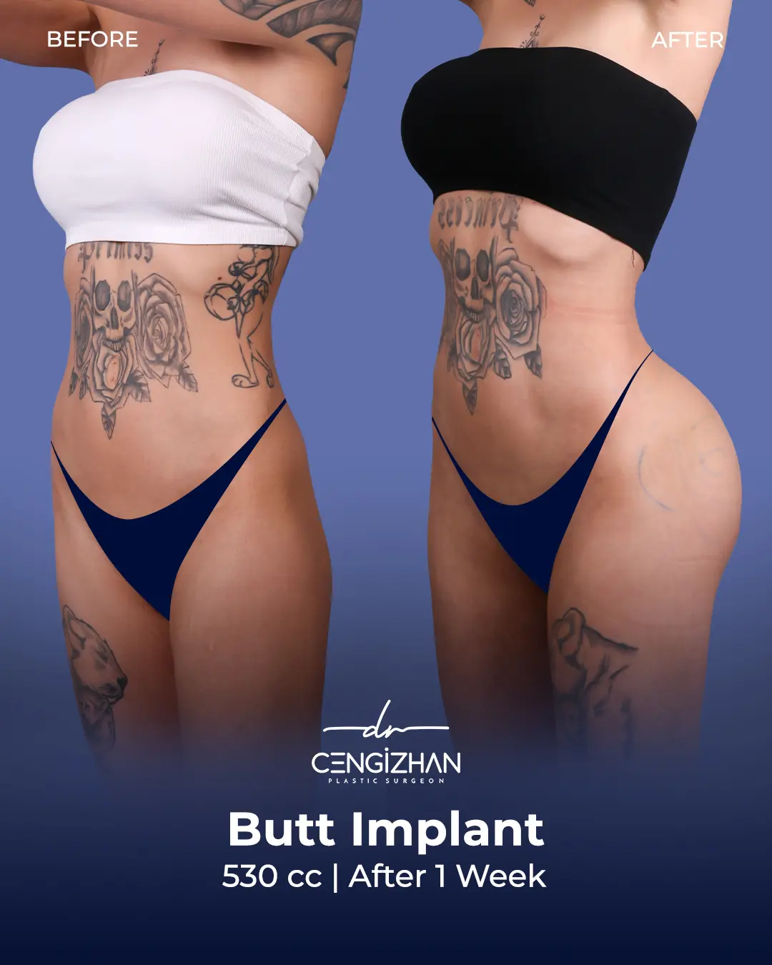 Butt Implants - Before and After - Real Transformation by Dr. Cengizhan Ekizceli