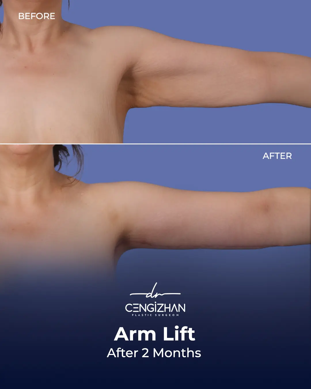 Arm Lift Results Before and After by Dr. Cengizhan Ekizceli