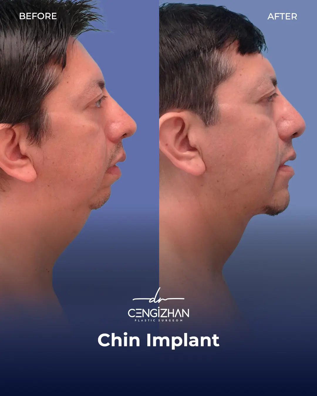 Chin Implant Real Patient Results by Dr. Cengizhan Ekizceli