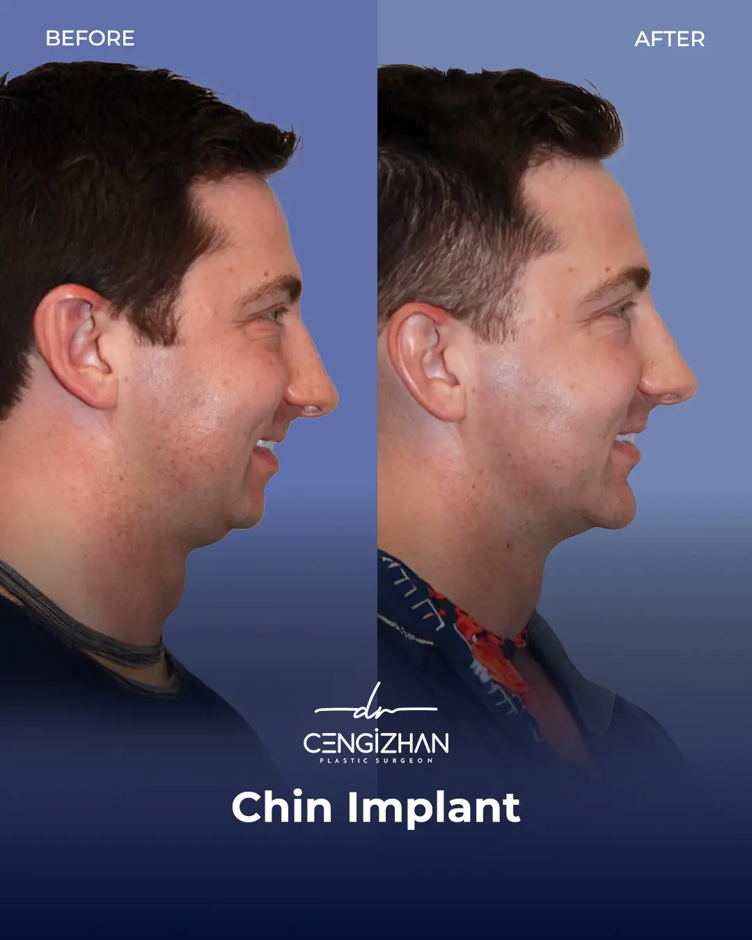 Chin Implant Real Patient Results by Dr. Cengizhan Ekizceli