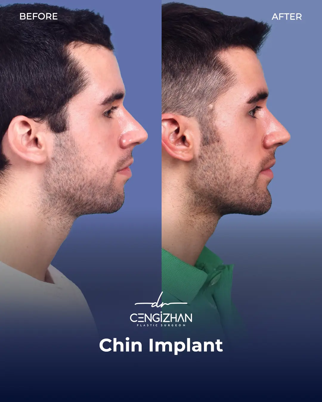 Chin Implant Real Patient Results by Dr. Cengizhan Ekizceli