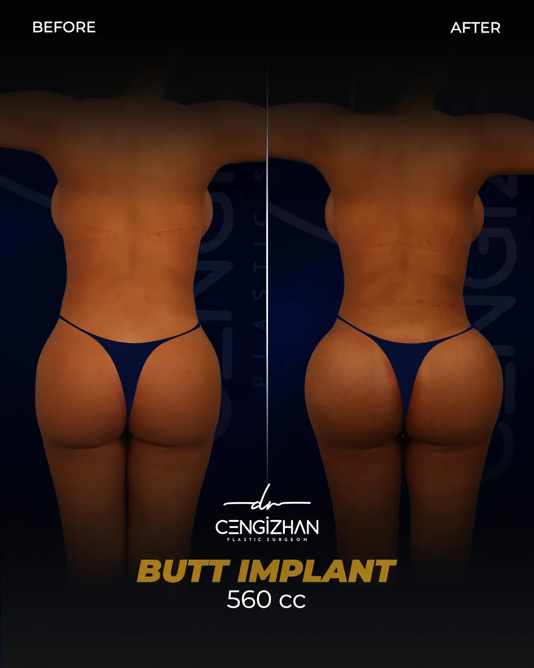 Butt Implants - Before and After - Real Transformation by Dr. Cengizhan Ekizceli
