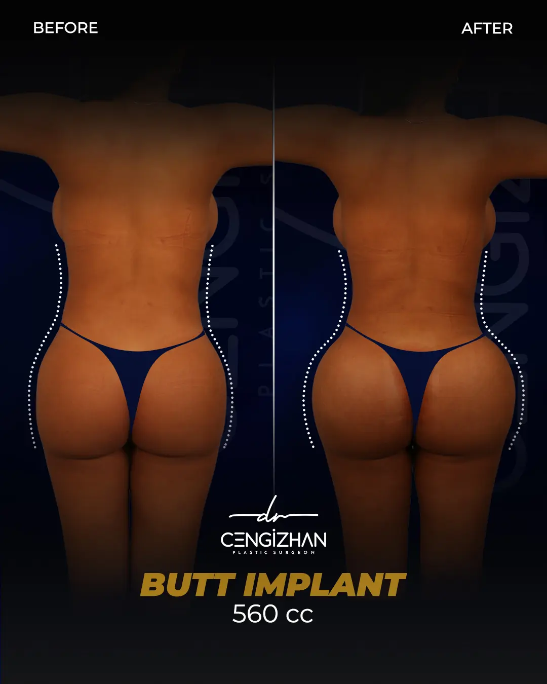 Butt Implants - Before and After - Real Transformation by Dr. Cengizhan Ekizceli