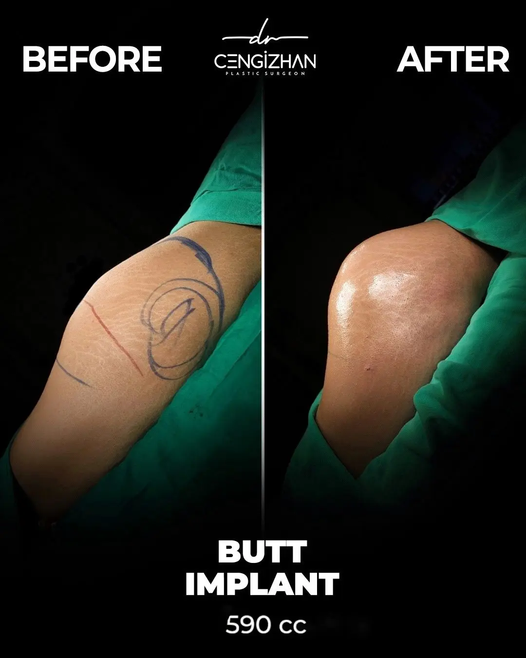 Butt Implants - Before and After - Real Transformation by Dr. Cengizhan Ekizceli