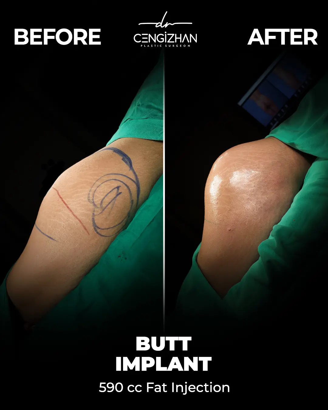 Butt Implants - Before and After - Real Transformation by Dr. Cengizhan Ekizceli