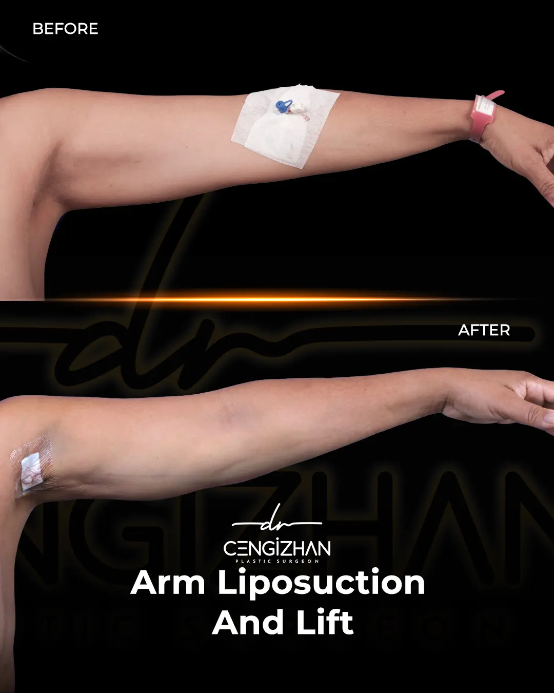 Arm Lift Results Before and After by Dr. Cengizhan Ekizceli
