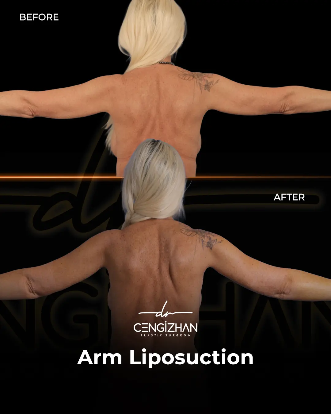 Arm Lift Results Before and After by Dr. Cengizhan Ekizceli