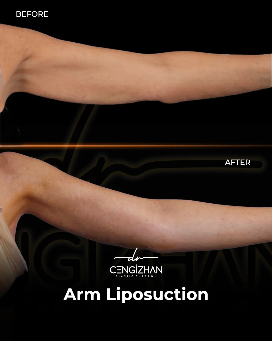 Arm Lift Results Before and After by Dr. Cengizhan Ekizceli