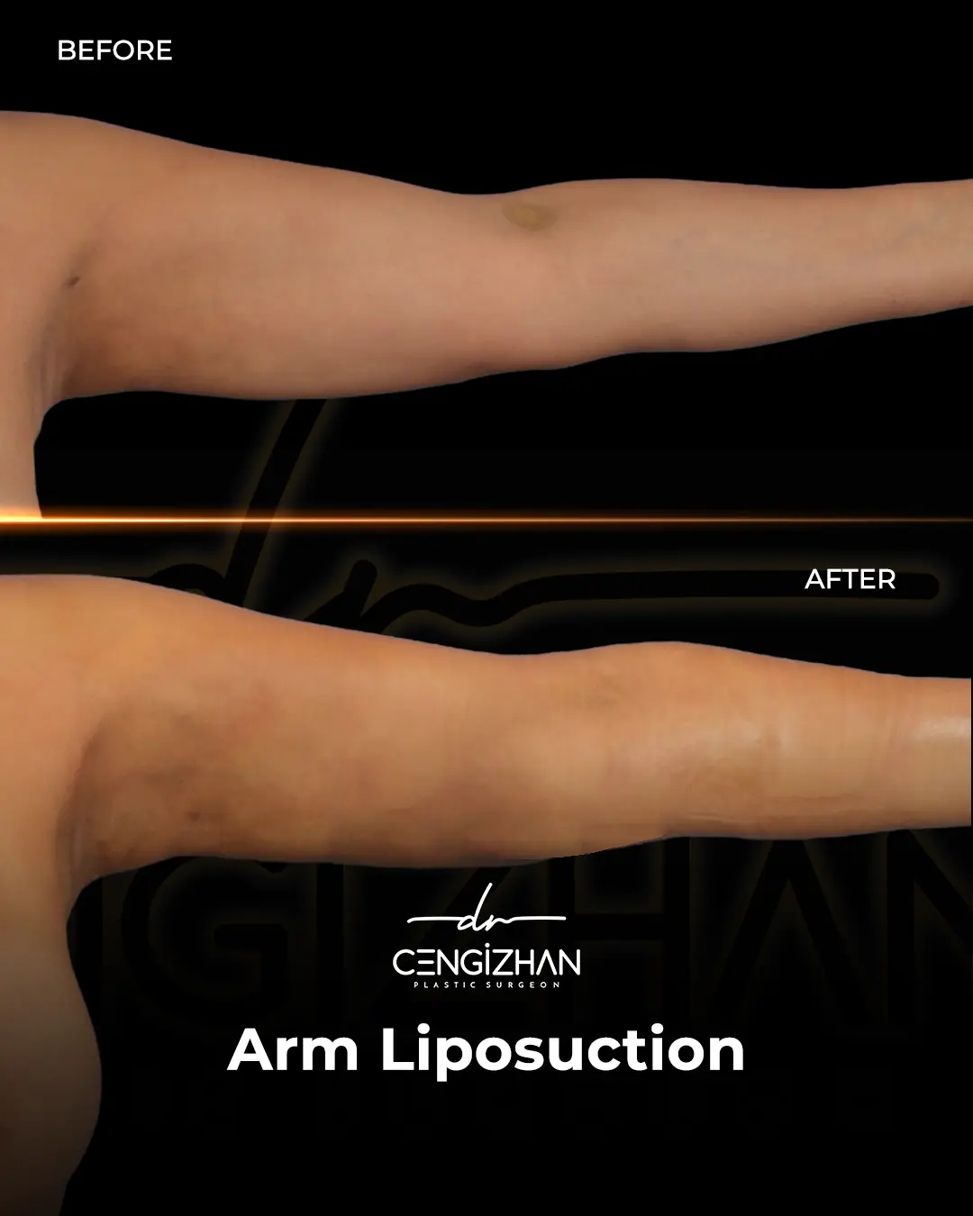 Arm Lift Results Before and After by Dr. Cengizhan Ekizceli