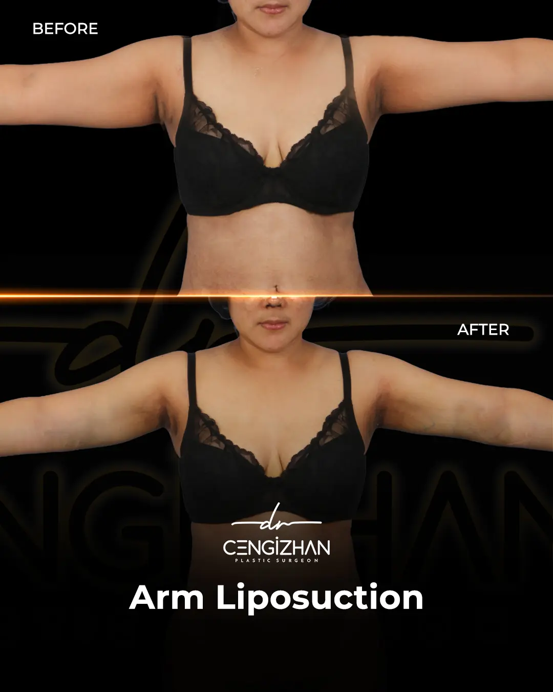 Arm Lift Results Before and After by Dr. Cengizhan Ekizceli