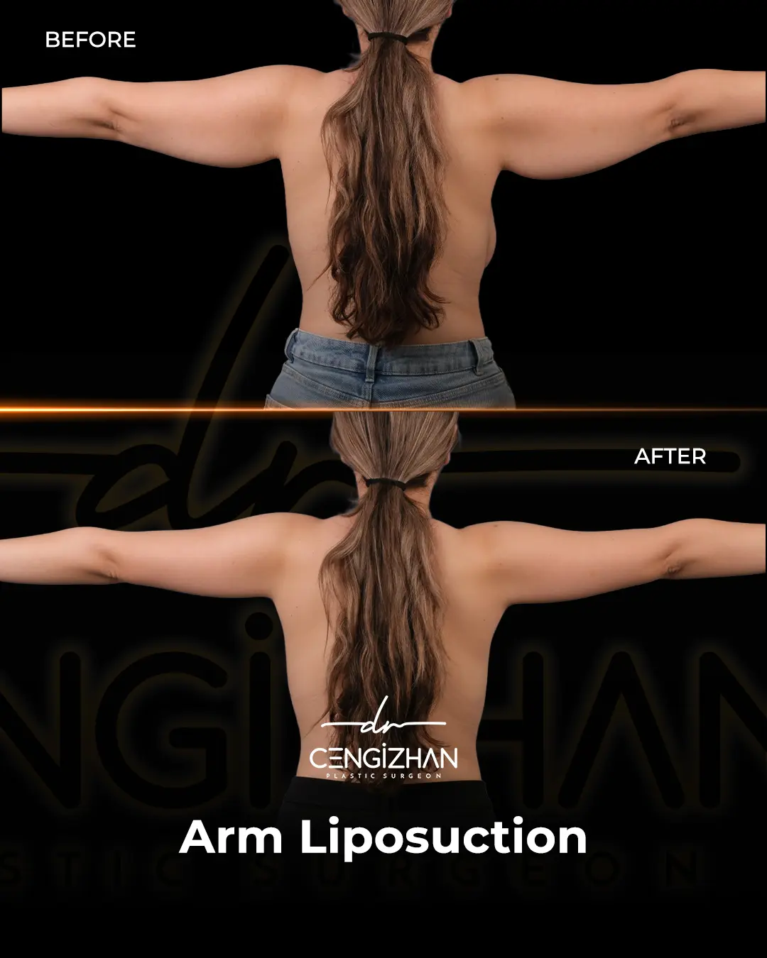 Arm Lift Results Before and After by Dr. Cengizhan Ekizceli