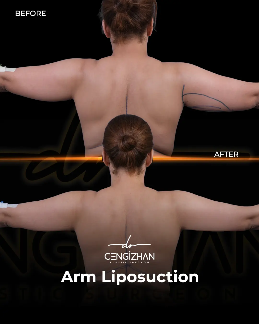 Arm Lift Results Before and After by Dr. Cengizhan Ekizceli