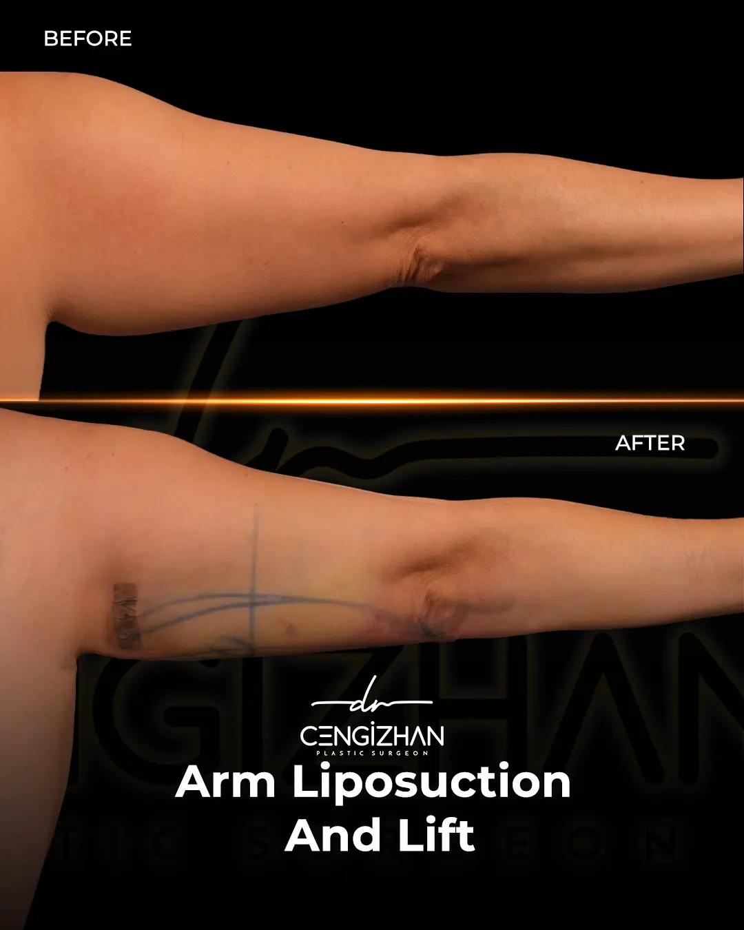 Arm Lift Results Before and After by Dr. Cengizhan Ekizceli