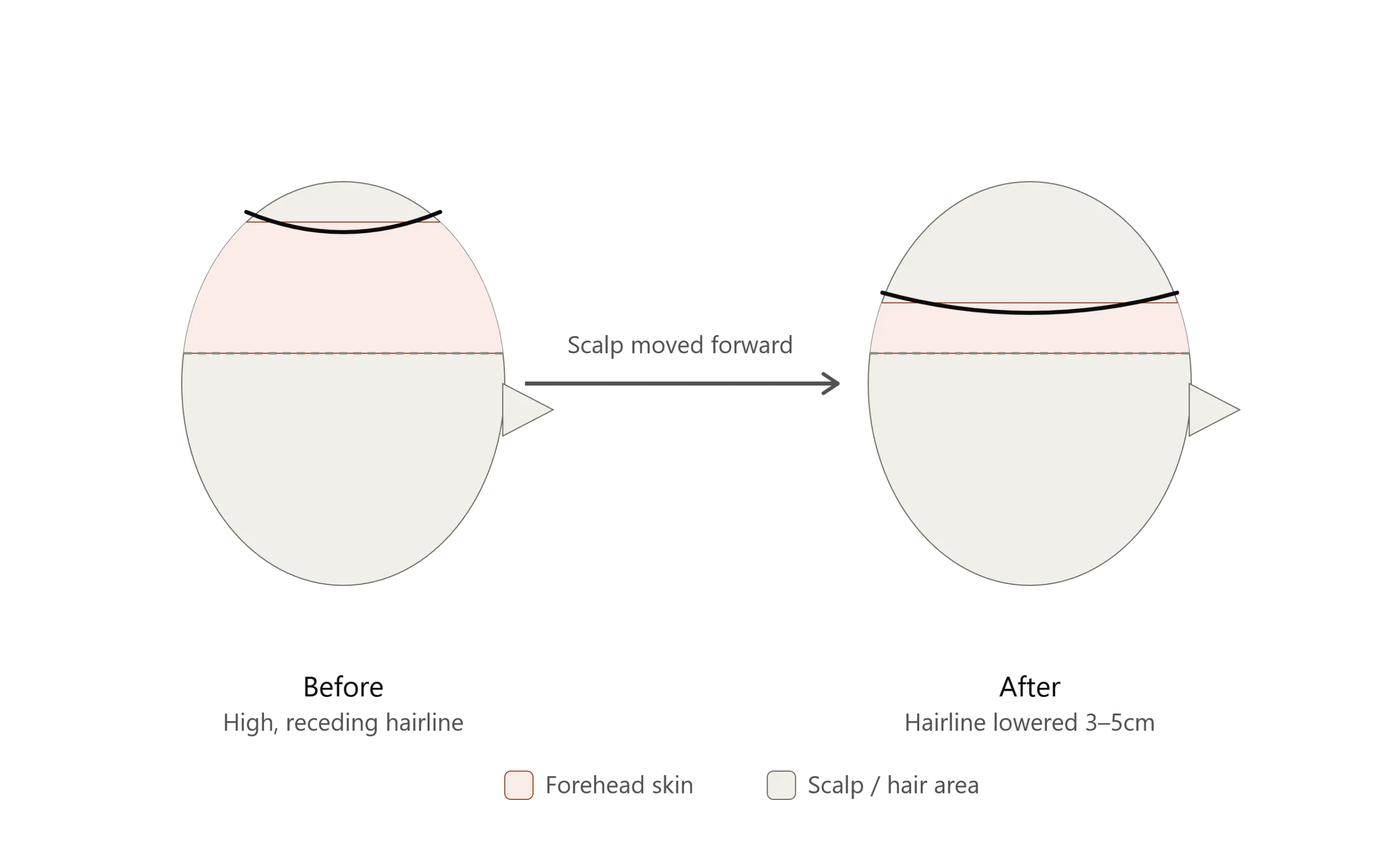 Diagram comparing two head profiles side by side: on the left, "Before" showing a high, receding hairline; on the right, "After" showing the hairline lowered by 3–5cm; an arrow labeled "Scalp moved forward" connects the two, with a legend below indicating forehead skin and scalp/hair area.
