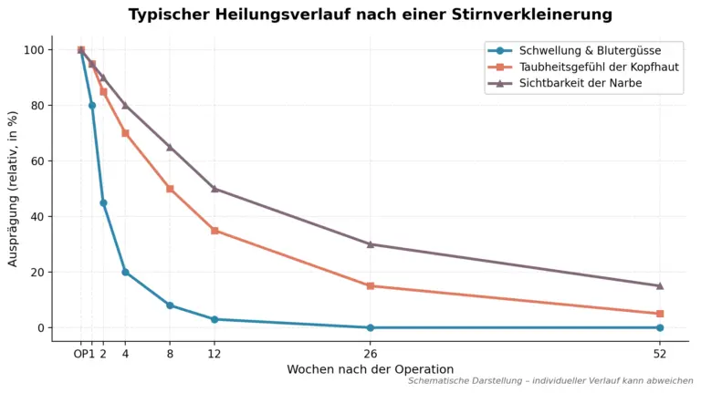 Liniendiagramm zum Heilungsverlauf nach einer Stirnverkleinerung: Schwellungen klingen nach etwa 4 Wochen ab, Taubheitsgefühl und Narbensichtbarkeit nehmen über 12 Monate schrittweise ab.