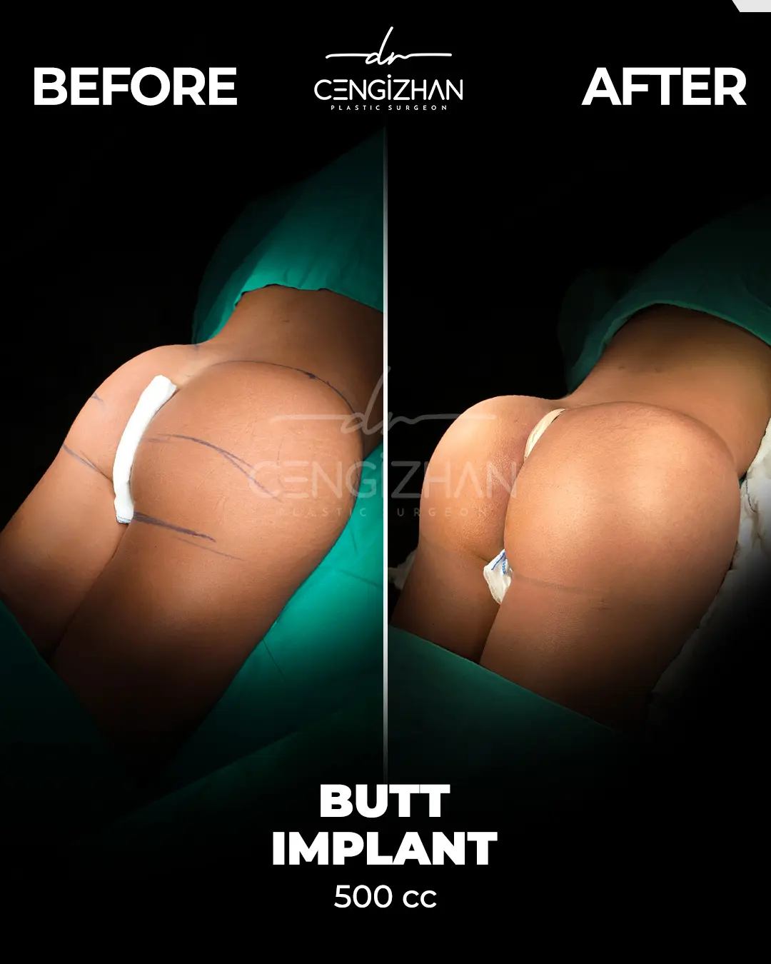 Butt Implants - Before and After - Real Transformation by Dr. Cengizhan Ekizceli