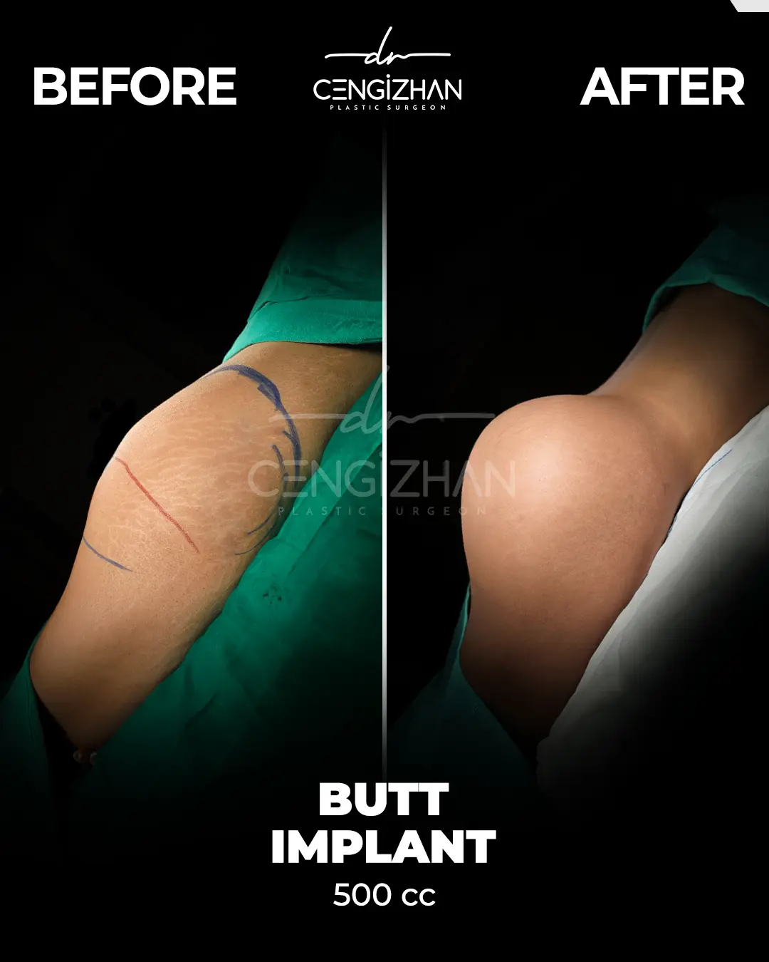 Butt Implants - Before and After - Real Transformation by Dr. Cengizhan Ekizceli