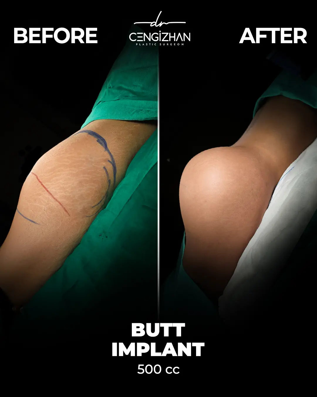 Butt Implants - Before and After - Real Transformation by Dr. Cengizhan Ekizceli