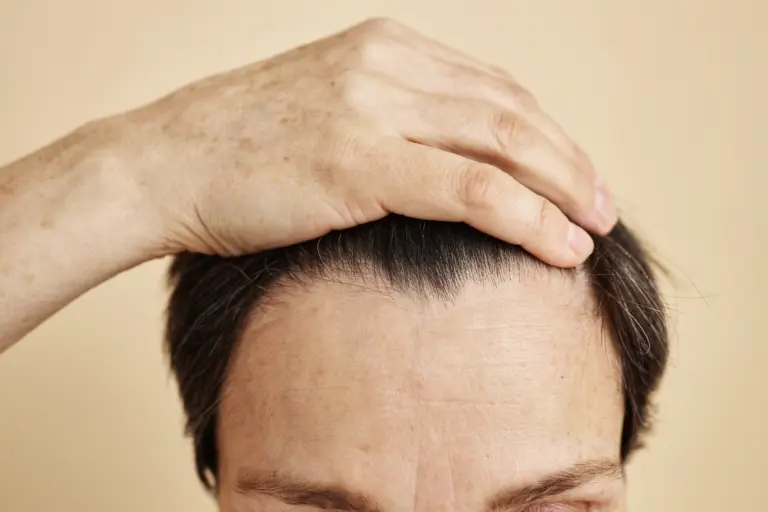 Man pulling back his hair to show the frontal hairline before considering forehead reduction surgery.