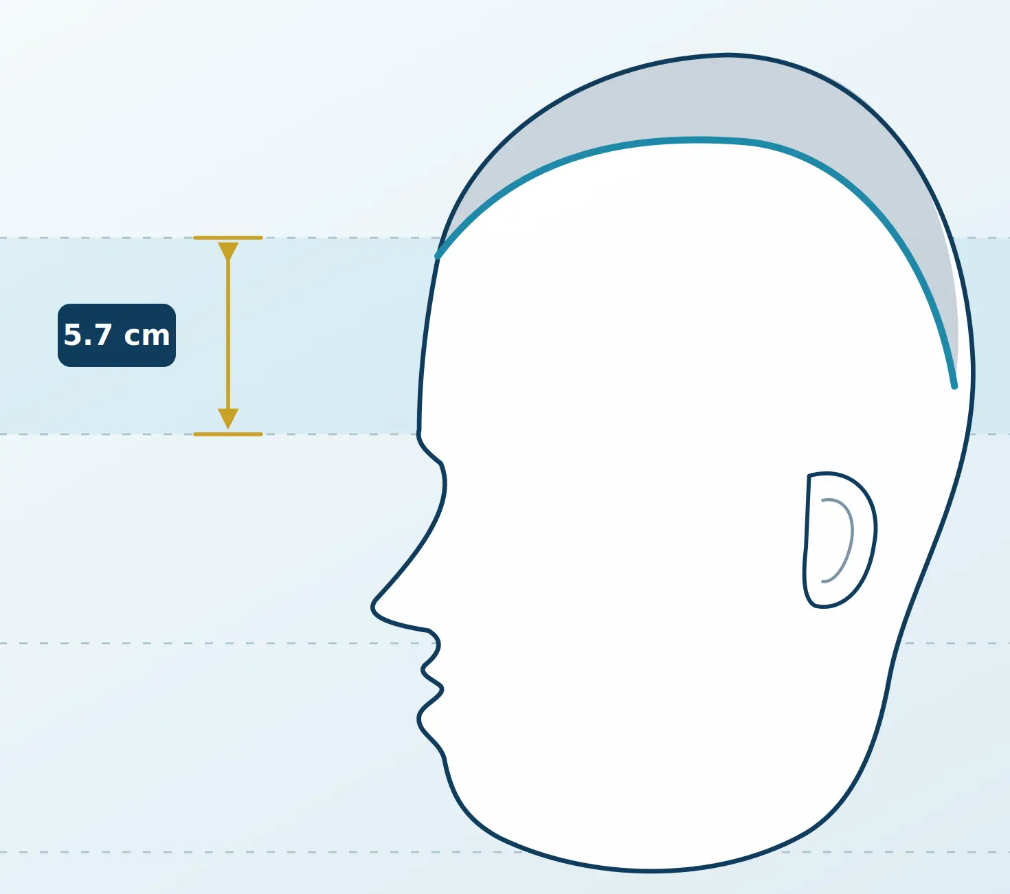 Diagramm eines Kopfprofils mit markierter Stirnhöhe von 5,7 cm und eingezeichnetem Bereich zur Veranschaulichung einer möglichen Stirnverkleinerung ohne Operation.