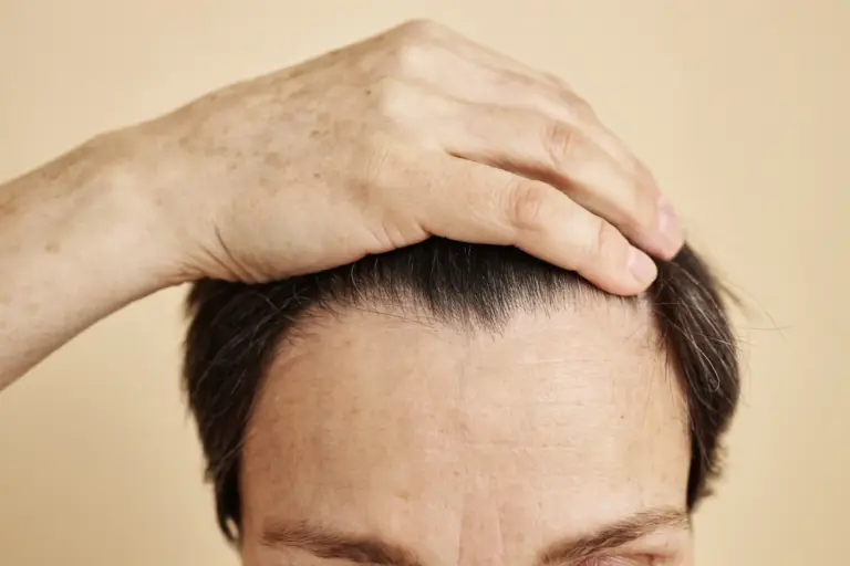 Mann hält seine Haare zurück, um Haaransatz und Stirnhöhe vor einer möglichen Stirnverkleinerung zu beurteilen.